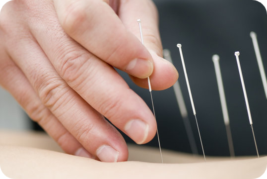 Acupuncture Treatment